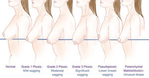 breaast-sagging-candidate-for-breast-augmentation-image