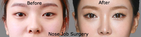 before-after-nose-job-rhinoplasty-surgery-image