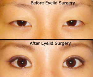 double-eyelid-surgery-before-after-photo